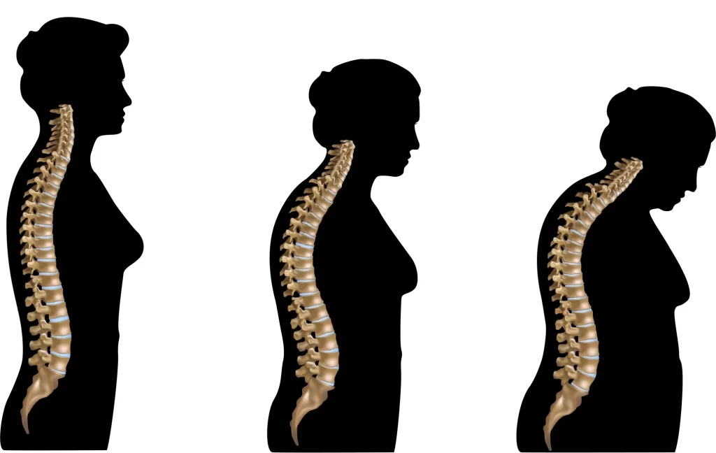 silhuetas de mulheres mostrando o efeito da osteoporose na coluna